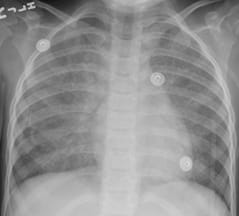 After whole lung lavage. After whole lung lavage.